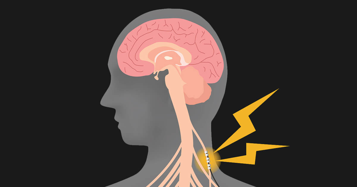 Common questions about vagus nerve stimulation