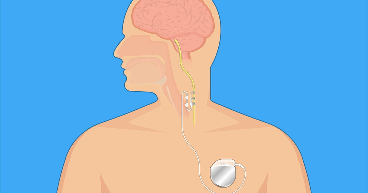 What is vagus nerve stimulation therapy?