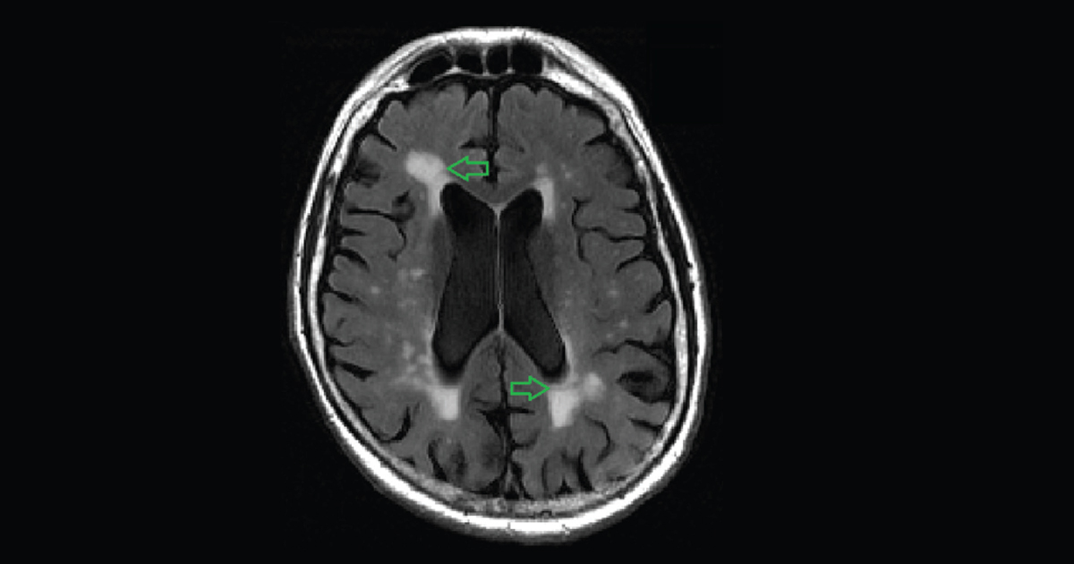 What are white matter lesions, and when are they a problem?
