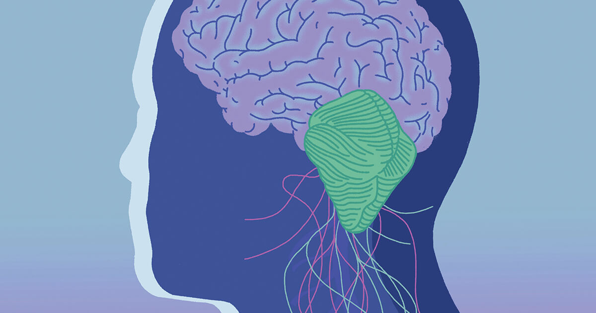 Chiari malformation: What to know about symptoms, diagnosis, and life after surgery