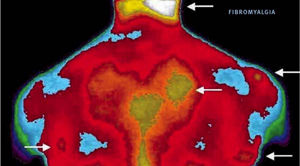 Is fibromyalgia a real thing? Or should you be skeptical?