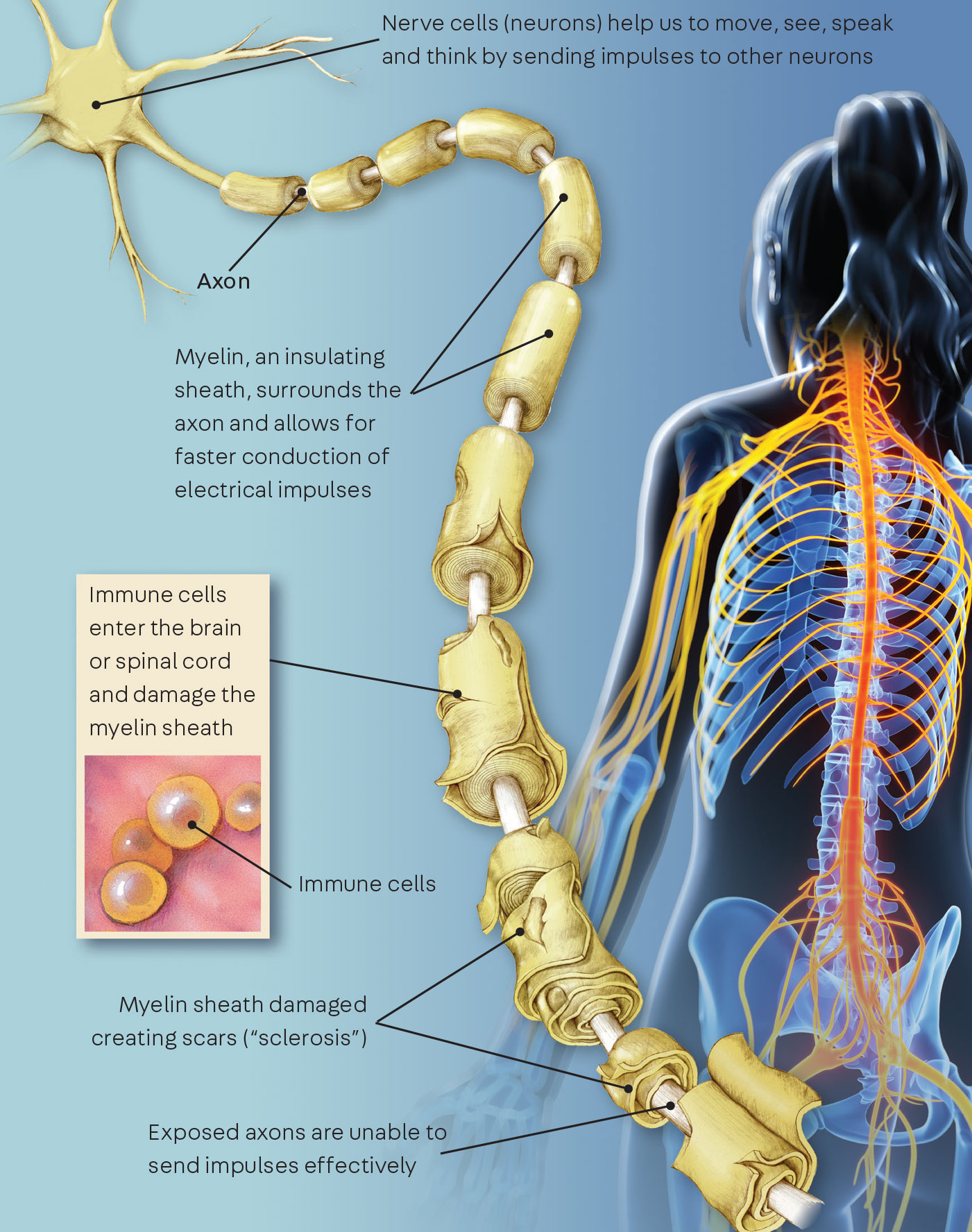 Diagram showing how multiple sclerosis damages the myelin sheath around nerve cells and disrupts nerve signals