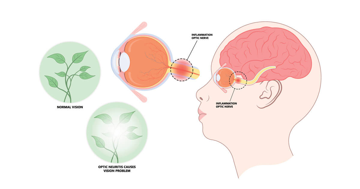 Neuromyelitis optica: What’s in a name?