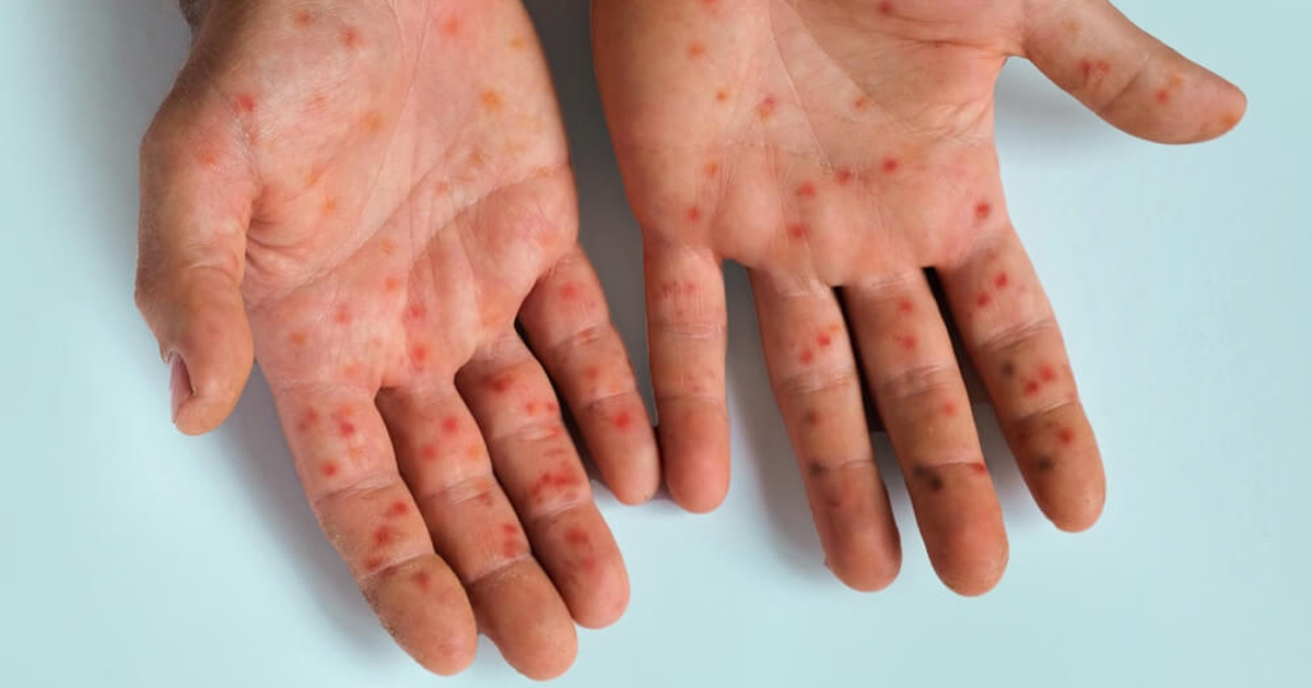Rising measles cases raise concerns about serious brain complications