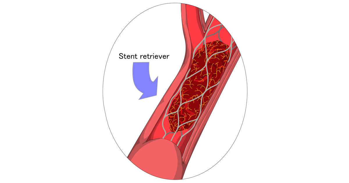 More stroke patients are now eligible for thrombectomy