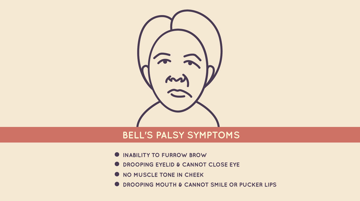Bouncing back from Bell's palsy