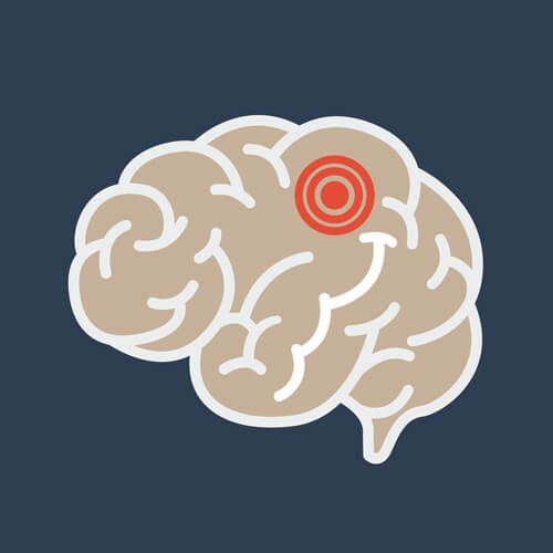 Illustration showing impact of tumor in a brain
